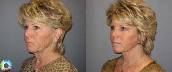 Before & After Mini Facelift Case 334 View #3 View in Golden, CO