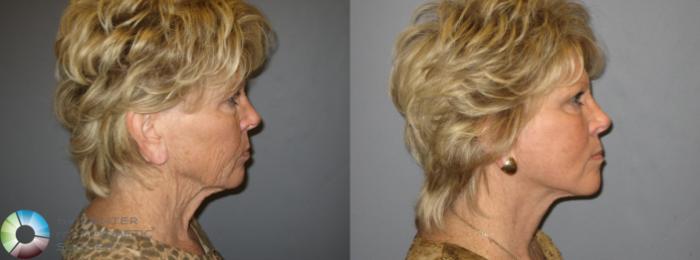Before & After Mini Facelift Case 334 View #4 View in Golden, CO