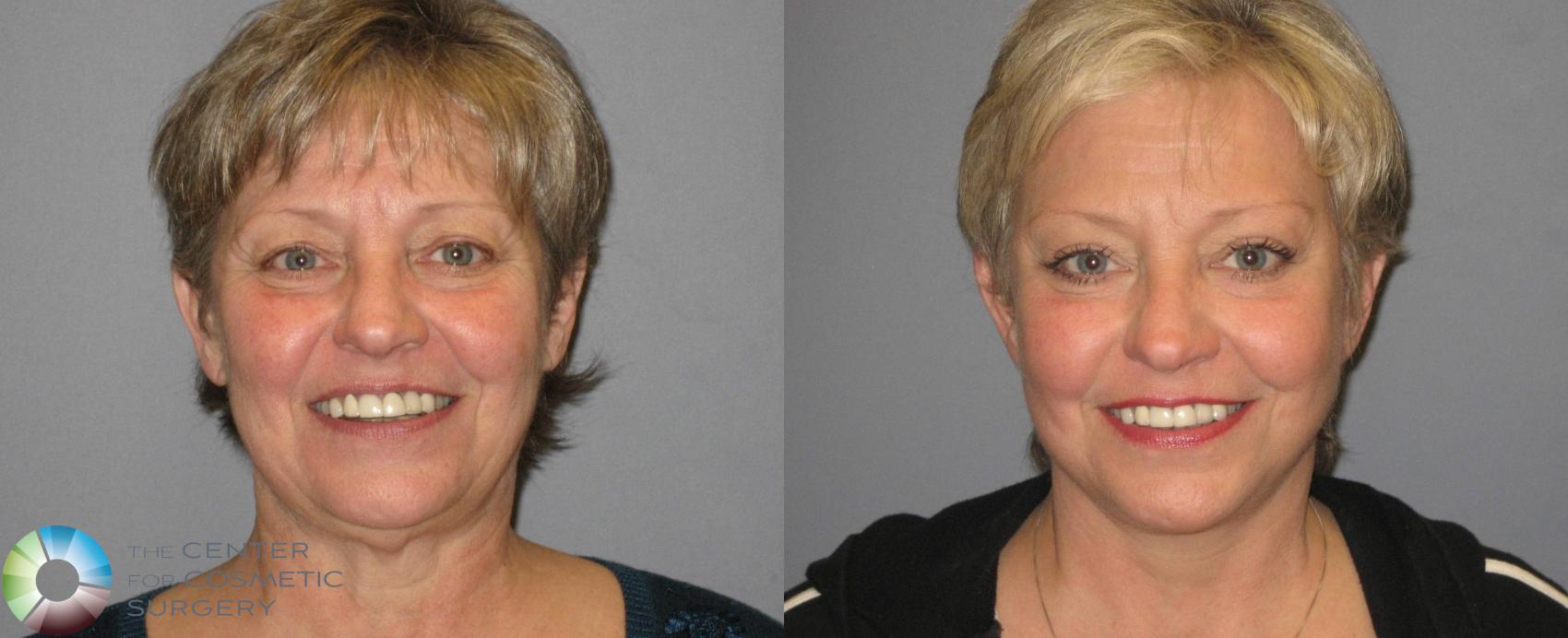 Before & After Mini Facelift Case 342 View #1 in Denver and Colorado Springs, CO