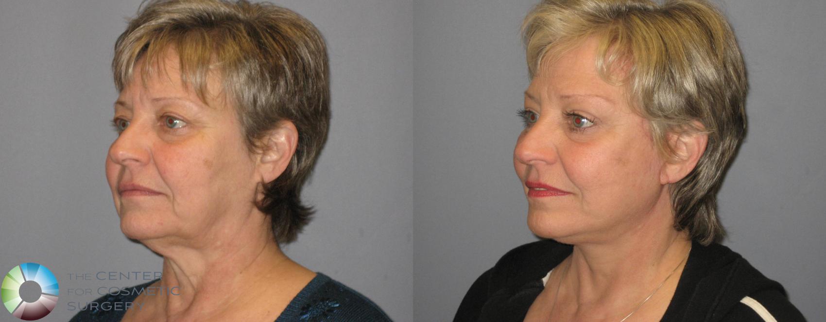 Before & After Mini Facelift Case 342 View #2 View in Denver & Golden, CO