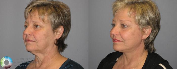 Before & After Mini Facelift Case 342 View #2 View in Golden, CO