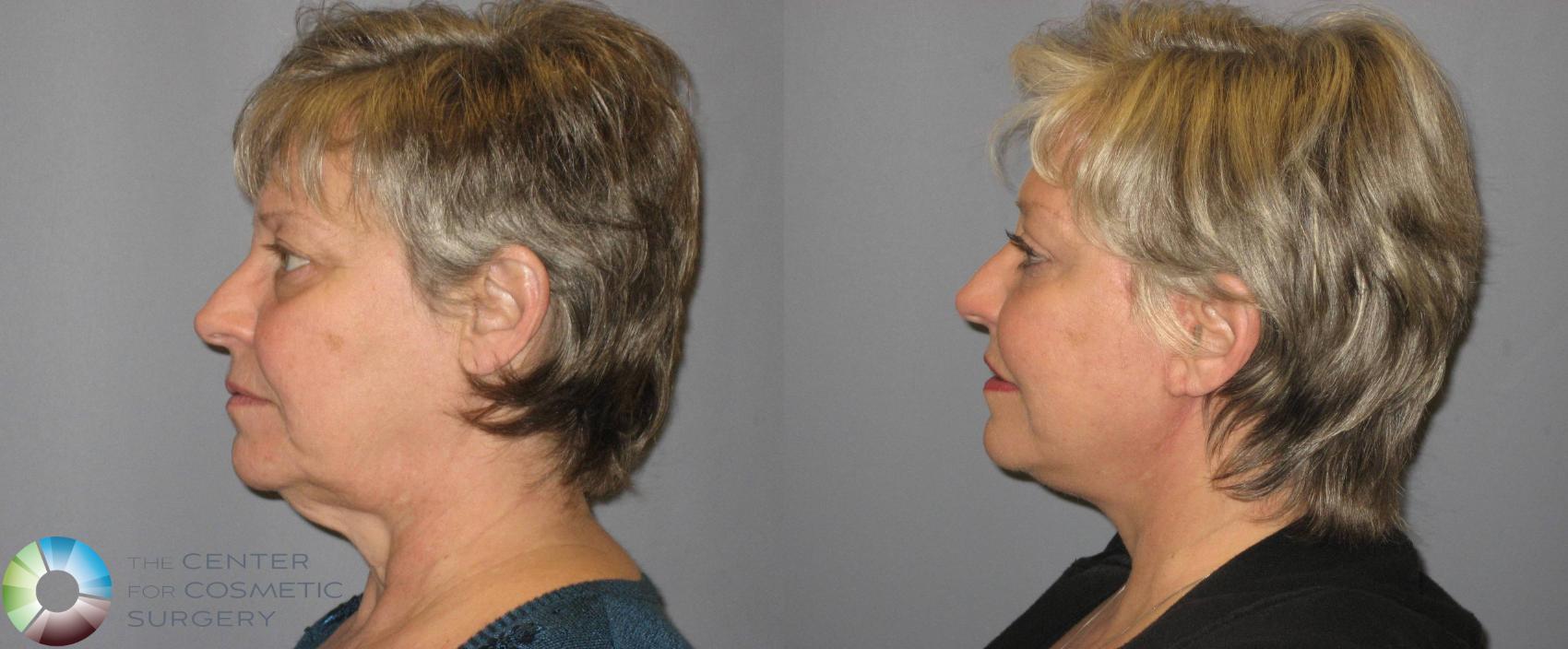 Before & After Mini Facelift Case 342 View #3 View in Denver & Golden, CO