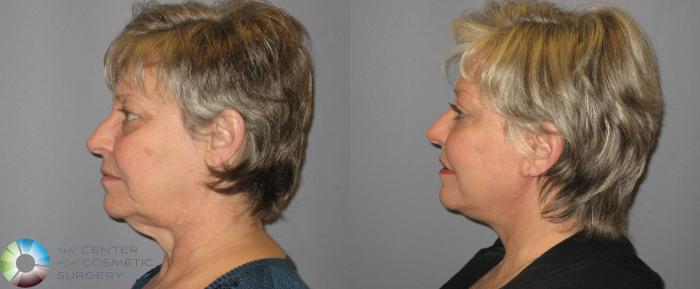 Before & After Mini Facelift Case 342 View #3 View in Golden, CO