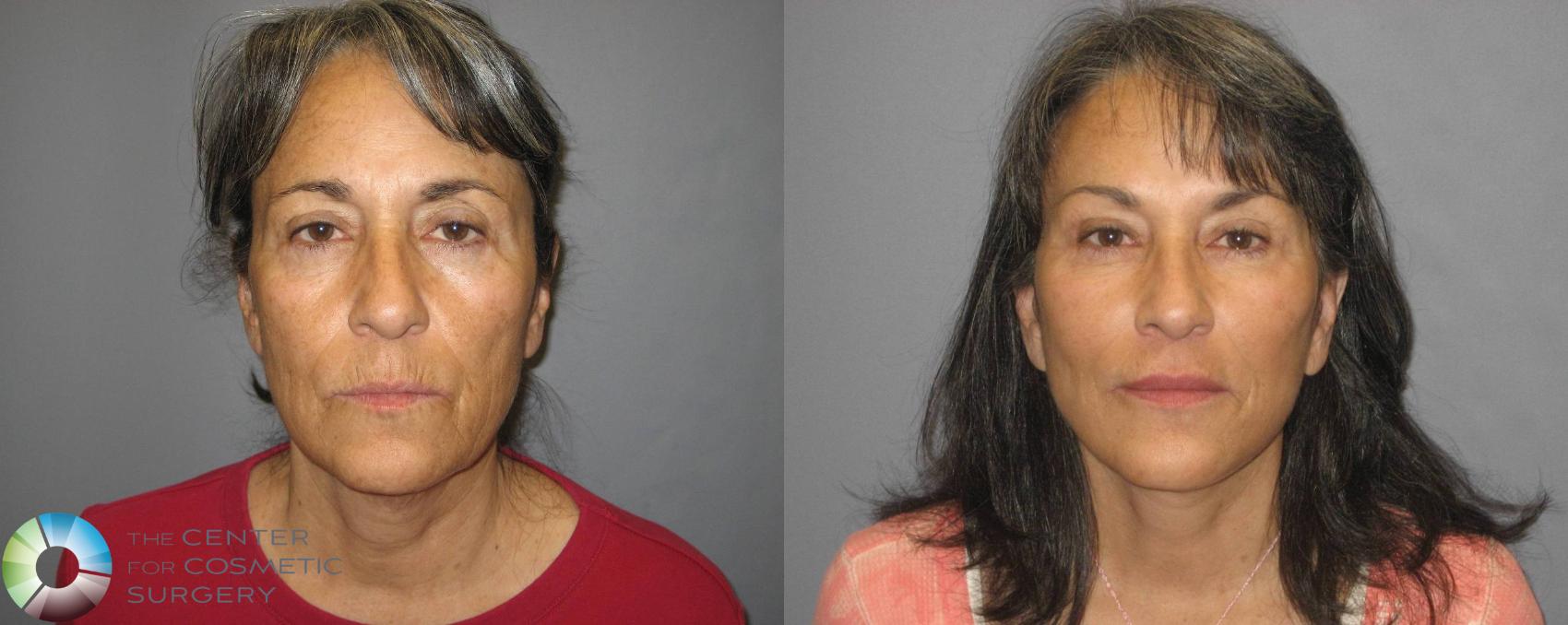 Before & After Facelift Case 358 View #1 in Denver and Colorado Springs, CO