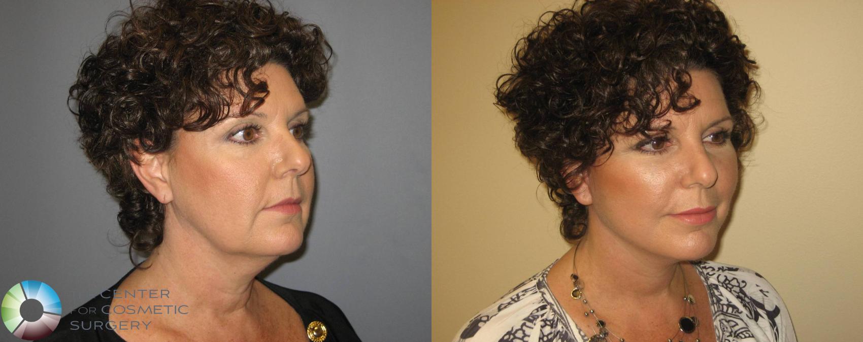 Before & After Mini Facelift Case 363 View #2 in Denver and Colorado Springs, CO