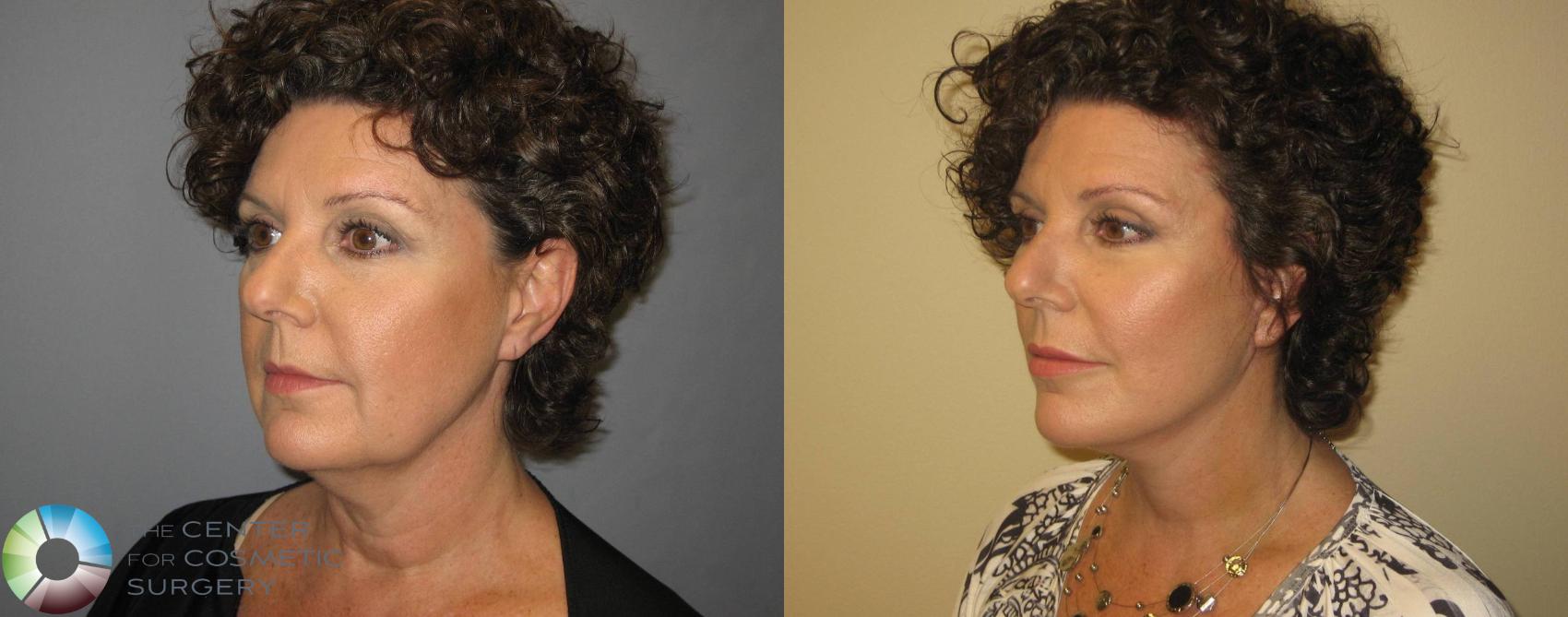 Before & After Mini Facelift Case 363 View #3 in Denver and Colorado Springs, CO