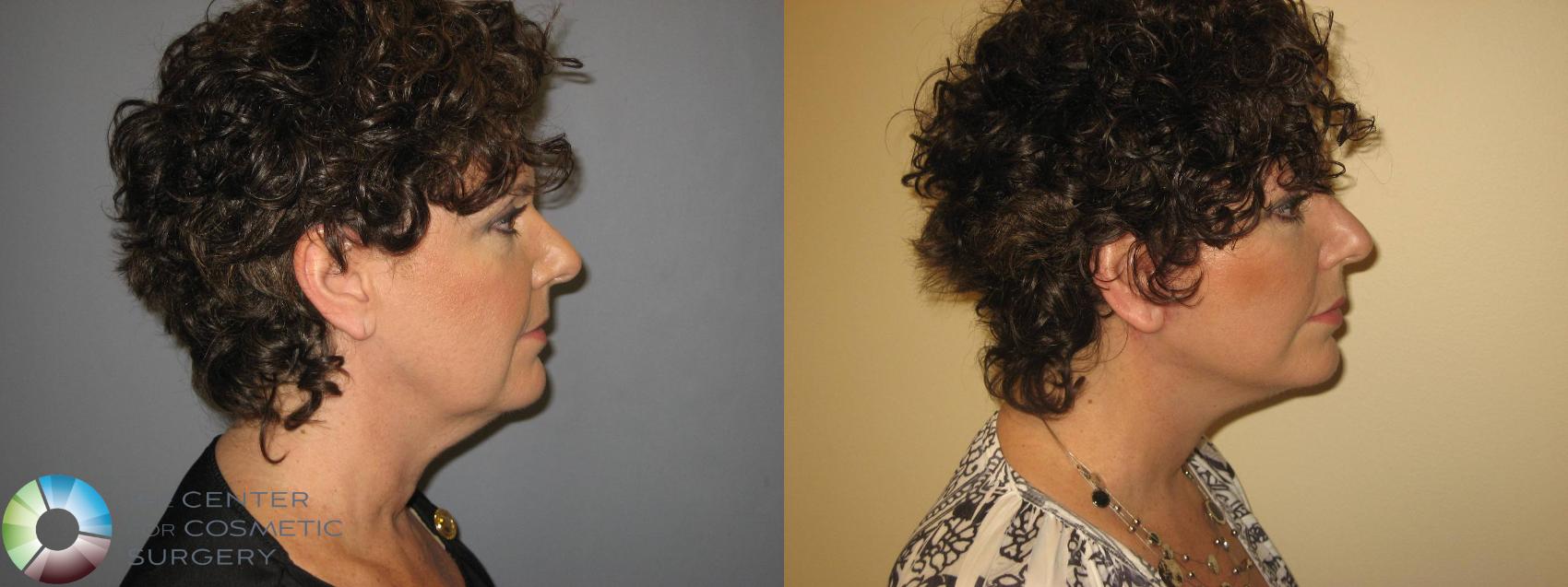 Before & After Mini Facelift Case 363 View #4 in Denver and Colorado Springs, CO