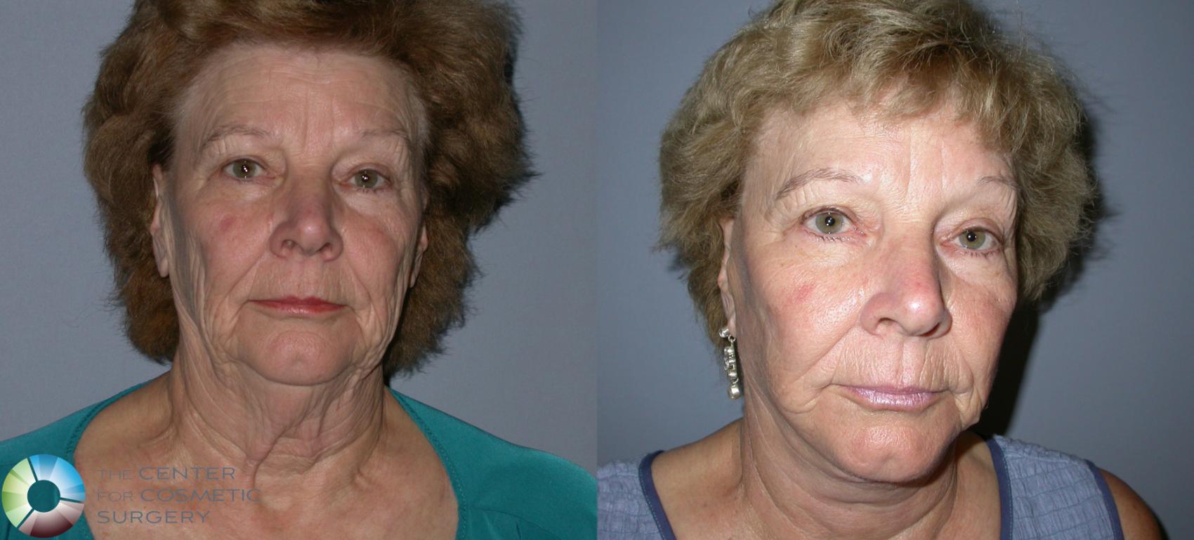 Before & After Mini Facelift Case 39 View #1 View in Golden, CO