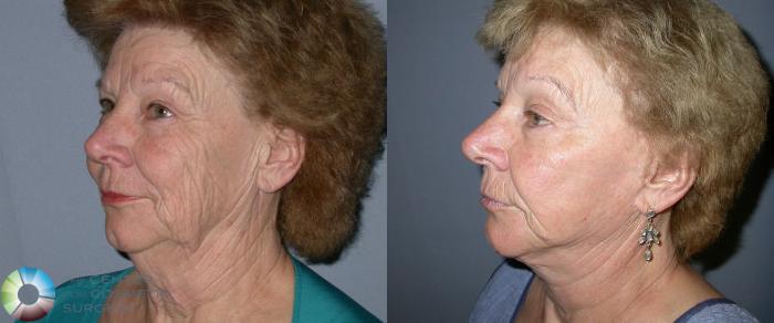 Before & After Mini Facelift Case 39 View #2 in Denver, CO