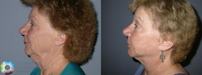 Before & After Mini Facelift Case 39 View #3 in Denver, CO