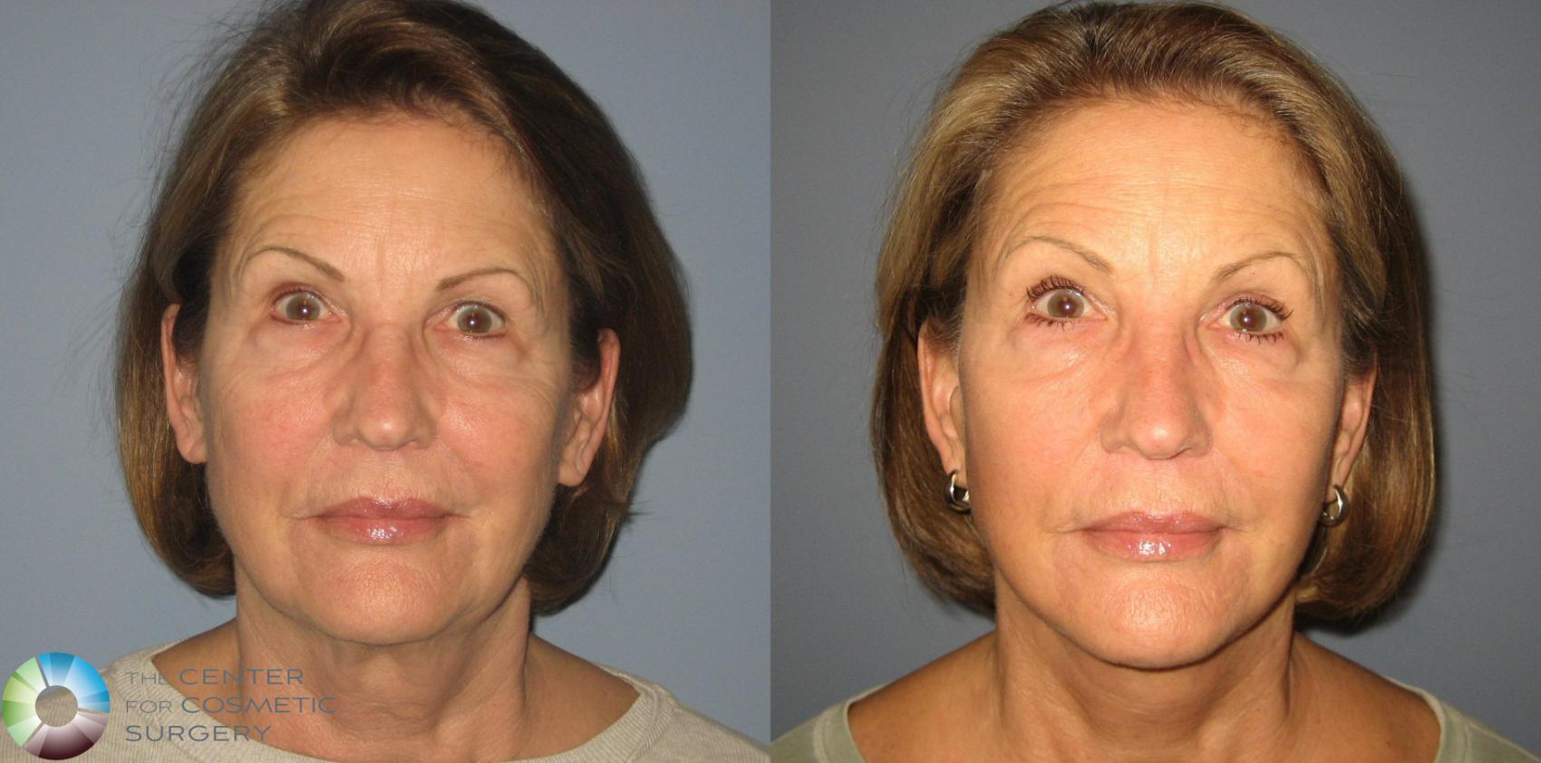 Before & After Mini Facelift Case 394 View #1 View in Golden, CO