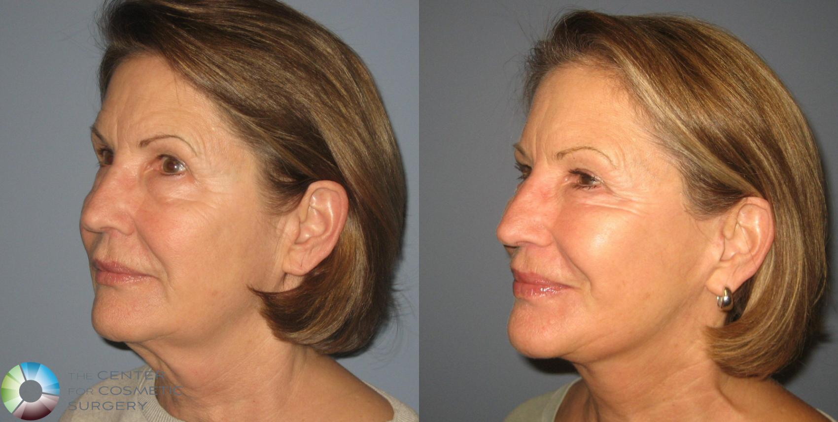 Before & After Mini Facelift Case 394 View #2 View in Golden, CO