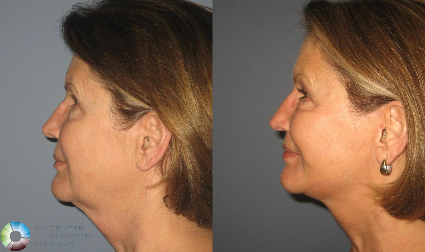 Before & After Mini Facelift Case 394 View #3 View in Golden, CO