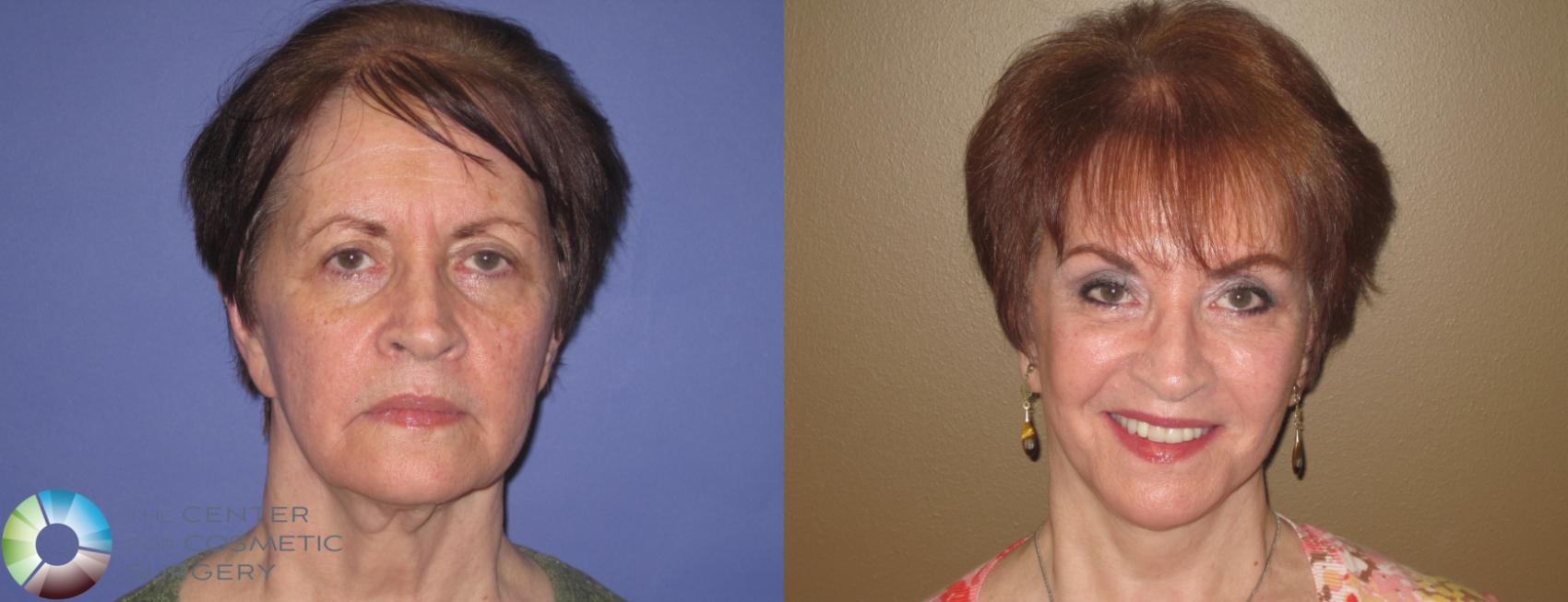 Before & After Mini Facelift Case 405 View #1 in Denver and Colorado Springs, CO