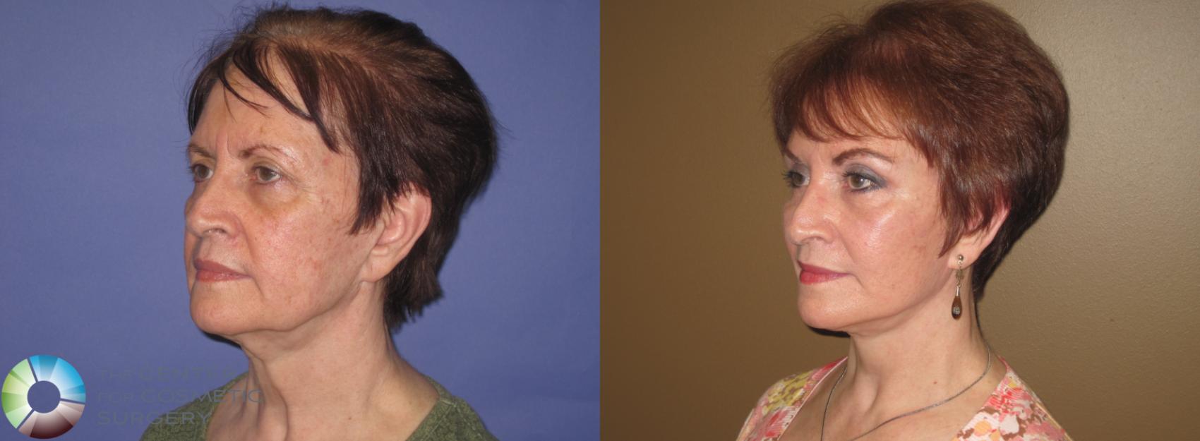 Before & After Mini Facelift Case 405 View #2 in Denver and Colorado Springs, CO
