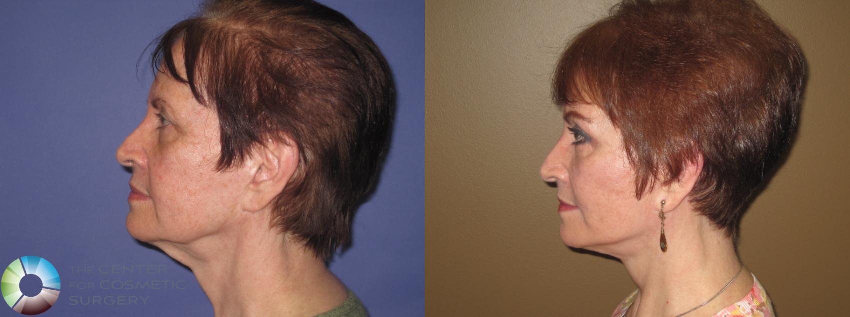 Before & After Mini Facelift Case 405 View #3 in Denver and Colorado Springs, CO