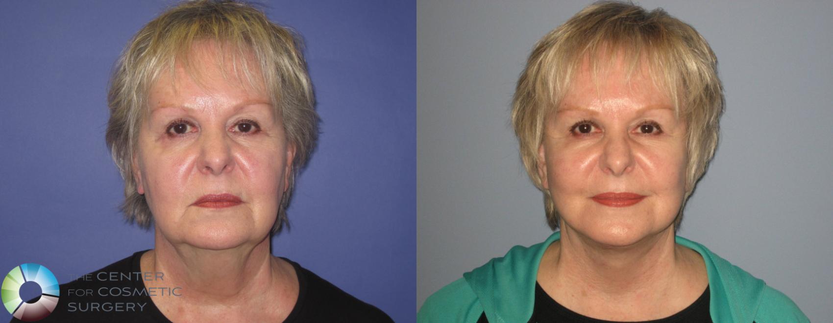 Before & After Facelift Case 406 View #1 in Denver and Colorado Springs, CO