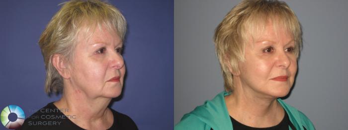 Before & After Facelift Case 406 View #2 View in Golden, CO