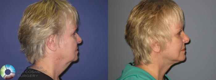 Before & After Mini Facelift Case 406 View #3 View in Golden, CO