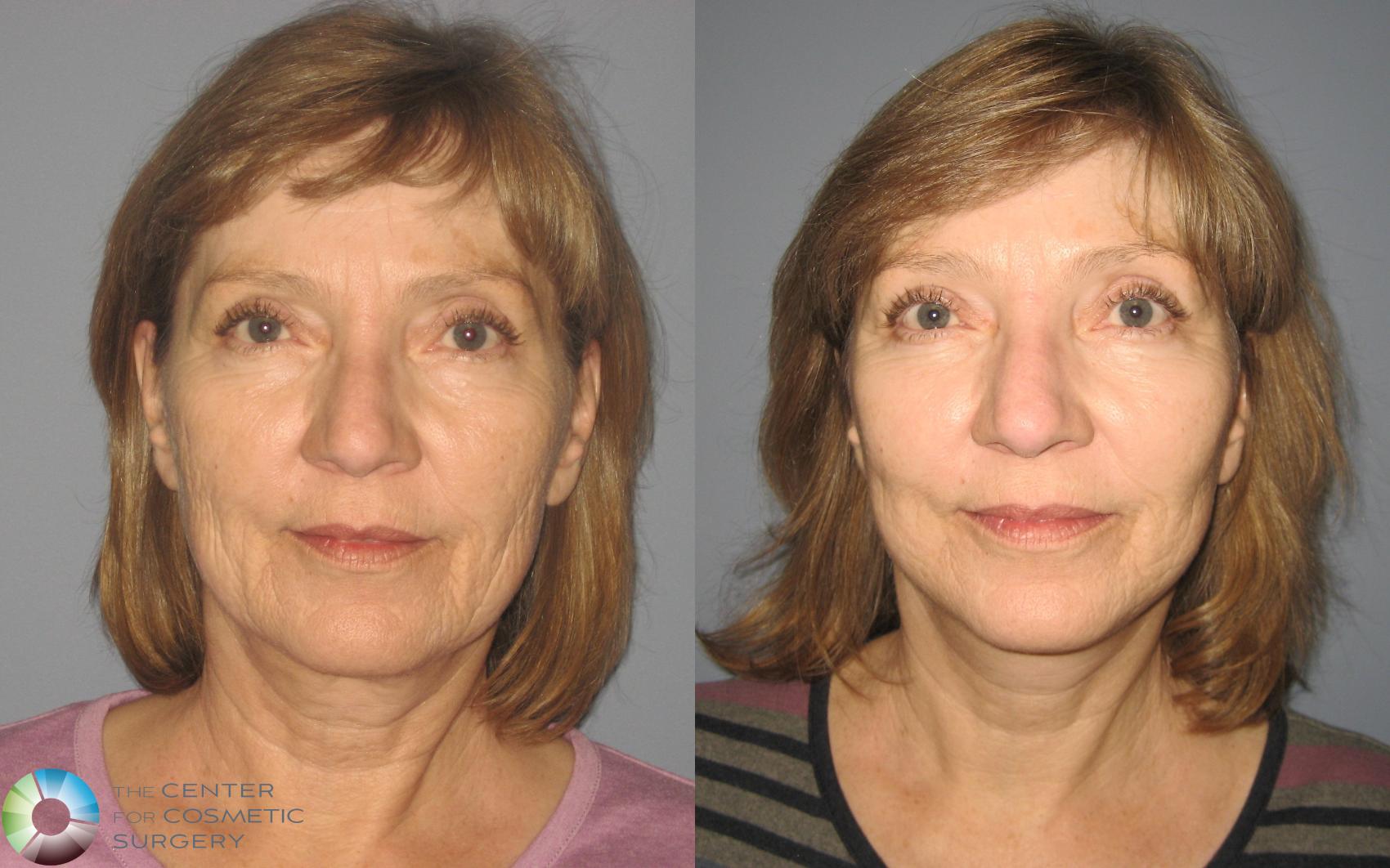 Before & After Eyelid Lift Case 443 View #1 View in Golden, CO