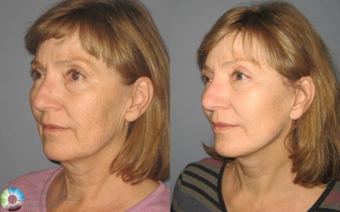 Before & After Eyelid Lift Case 443 View #2 View in Golden, CO
