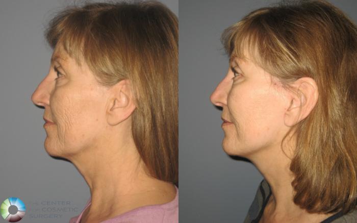 Before & After Mini Facelift Case 443 View #3 View in Golden, CO