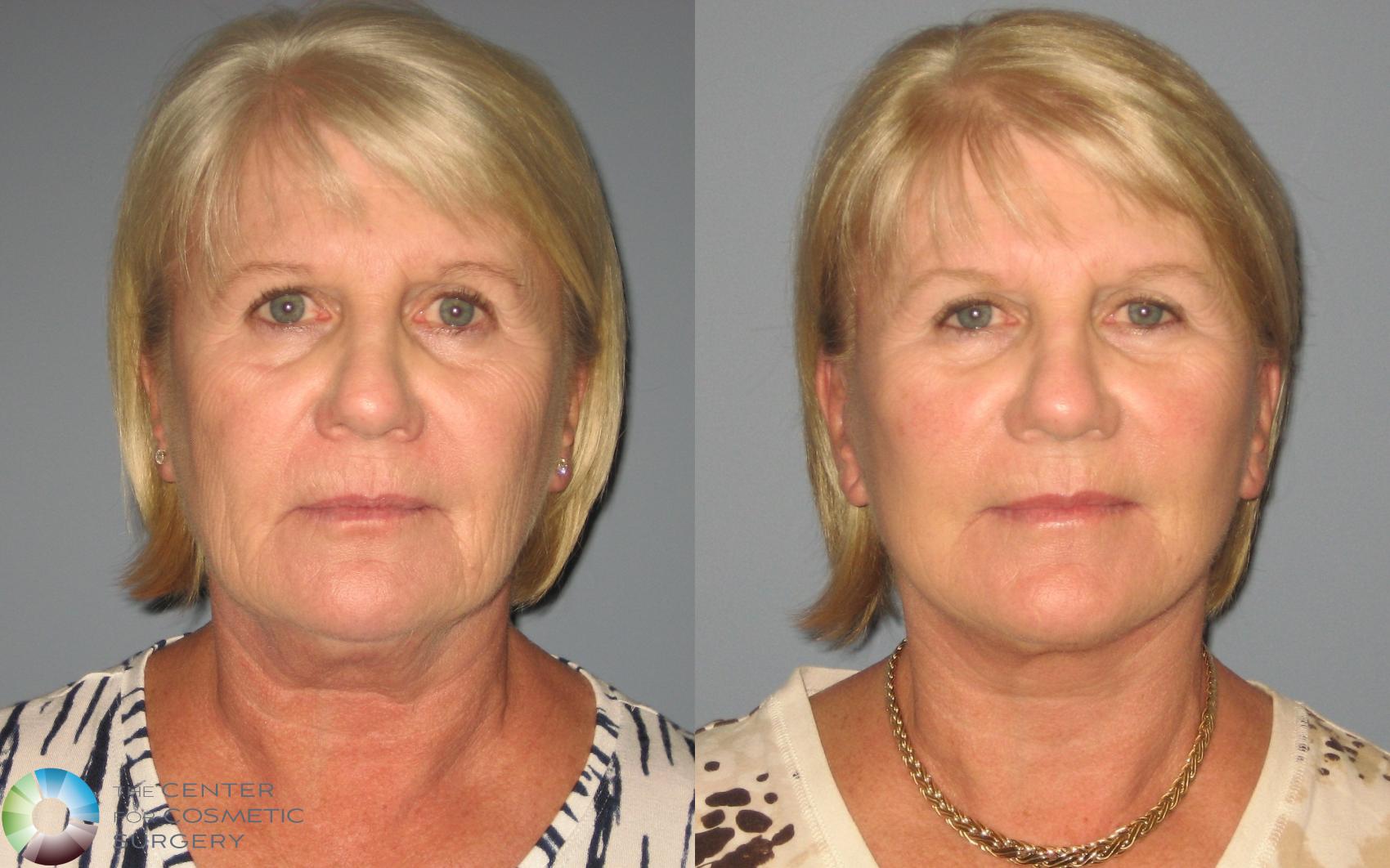 Before & After Mini Facelift Case 445 View #1 in Denver and Colorado Springs, CO