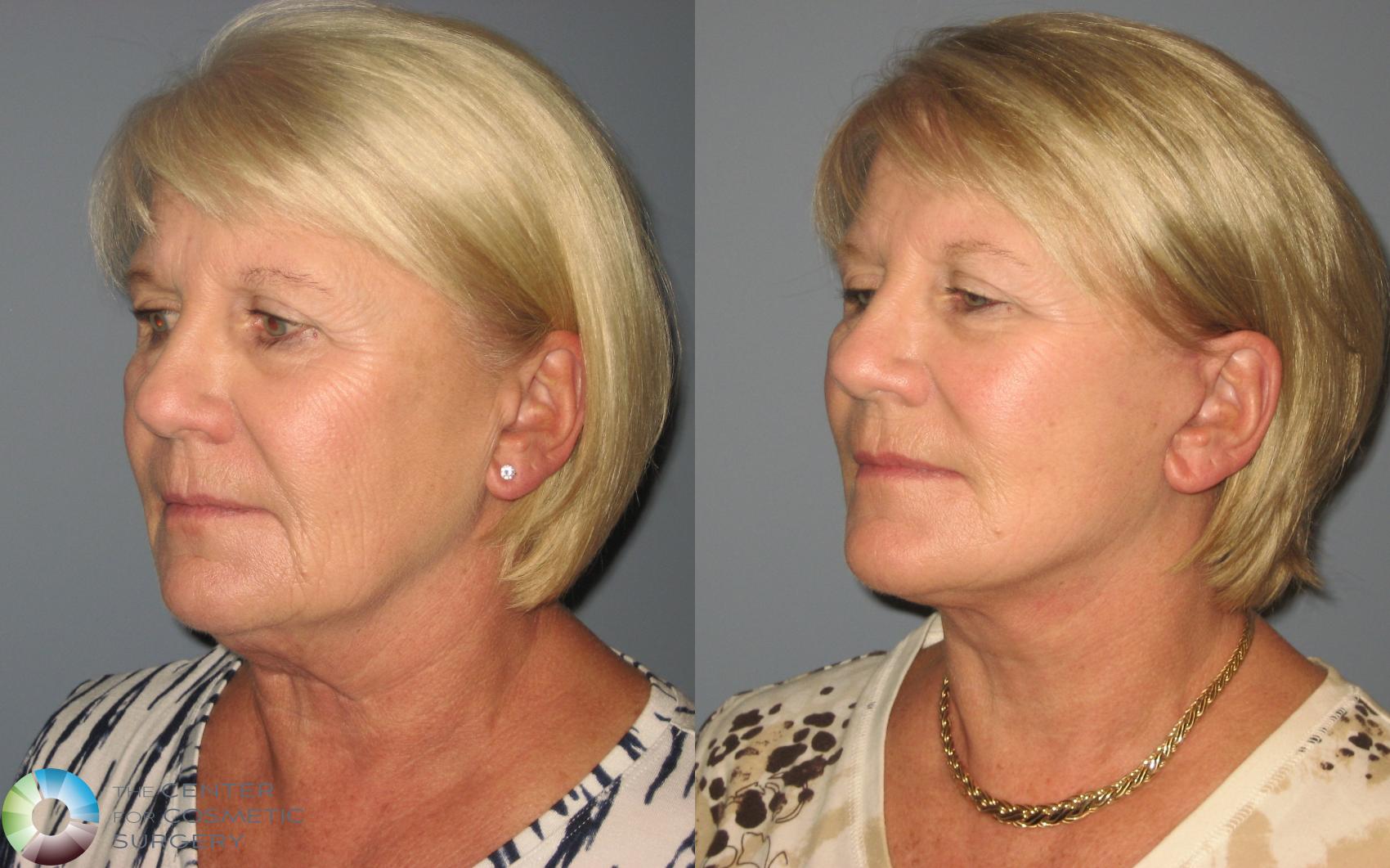 Before & After Mini Facelift Case 445 View #2 in Denver and Colorado Springs, CO
