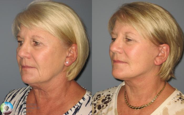 Before & After Mini Facelift Case 445 View #2 View in Golden, CO
