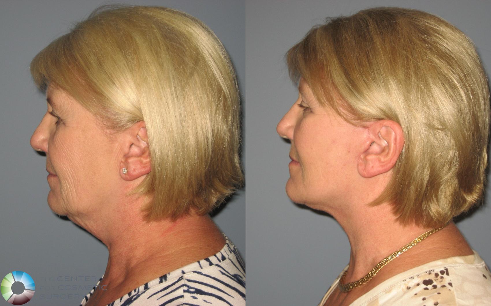 Before & After Mini Facelift Case 445 View #3 in Denver and Colorado Springs, CO