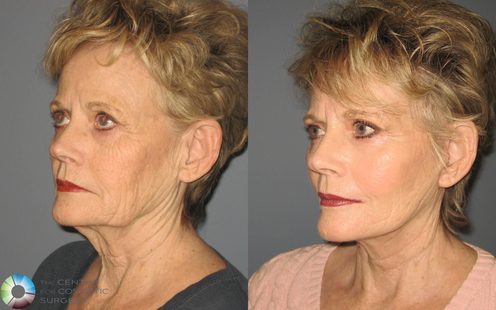Before & After Mini Facelift Case 453 View #2 View in Denver & Golden, CO