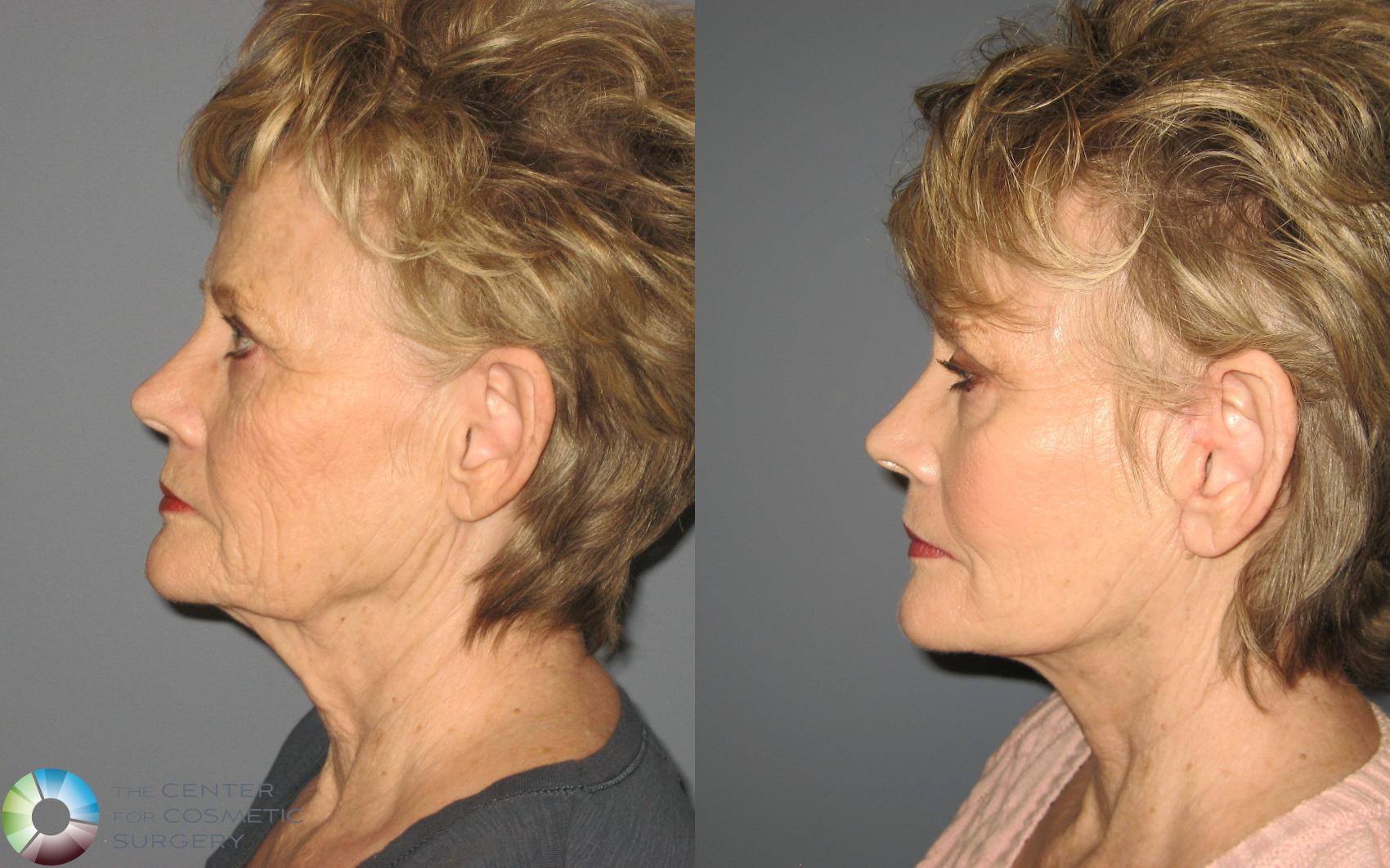 Before & After Mini Facelift Case 453 View #3 View in Golden, CO