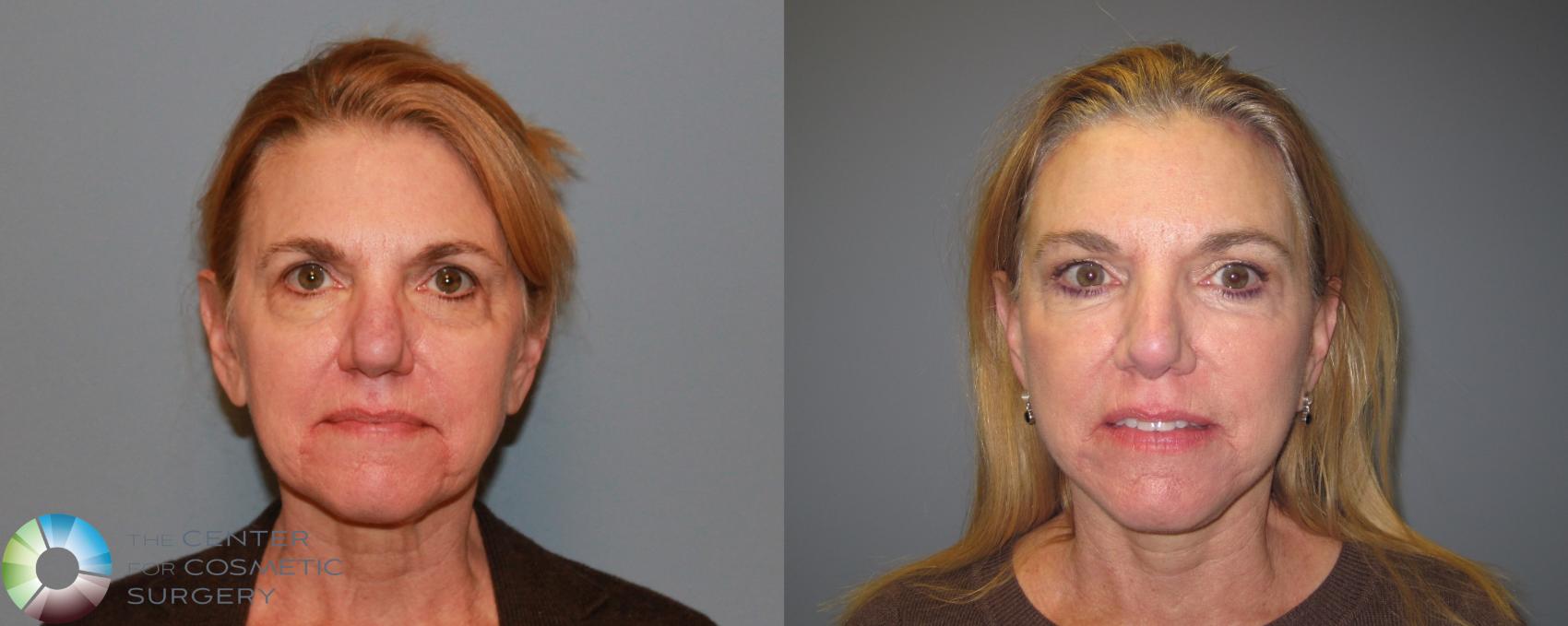 Before & After Laser Skin Resurfacing Case 459 View #1 View in Golden, CO