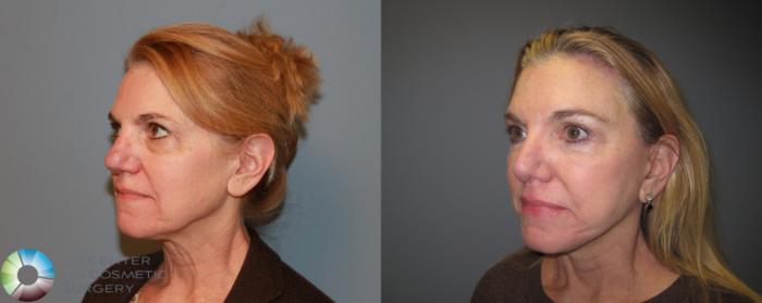 Before & After Laser Skin Resurfacing Case 459 View #2 View in Golden, CO