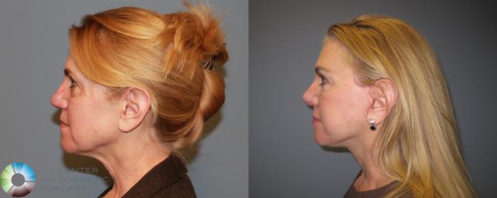 Before & After Mini Facelift Case 459 View #3 View in Golden, CO