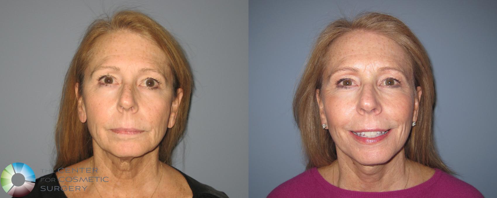 Before & After Mini Facelift Case 463 View #1 in Denver and Colorado Springs, CO