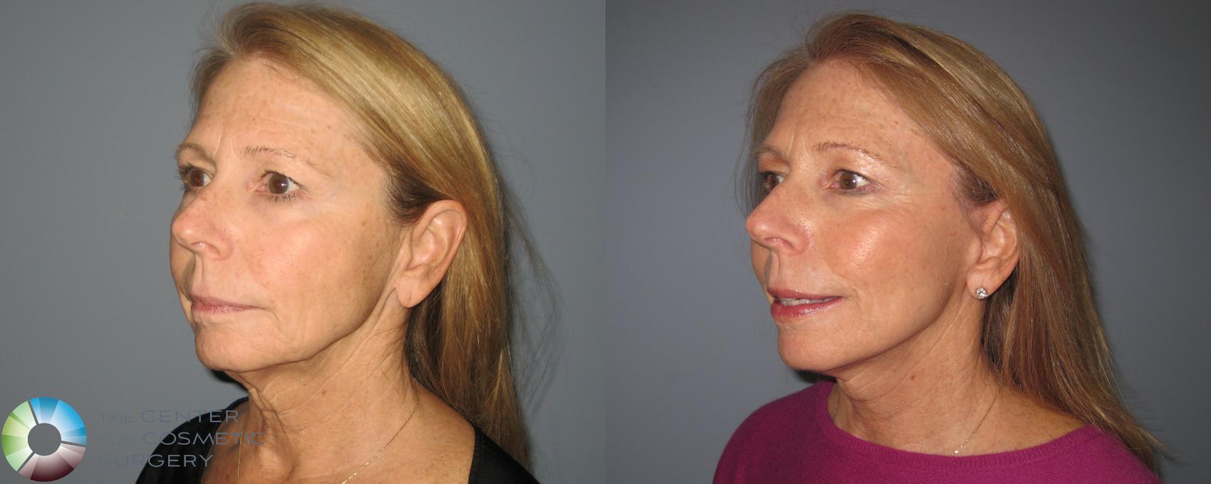 Before & After Mini Facelift Case 463 View #2 in Denver and Colorado Springs, CO