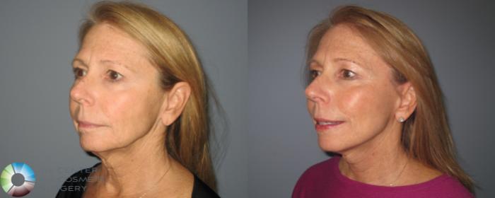 Before & After Mini Facelift Case 463 View #2 View in Golden, CO