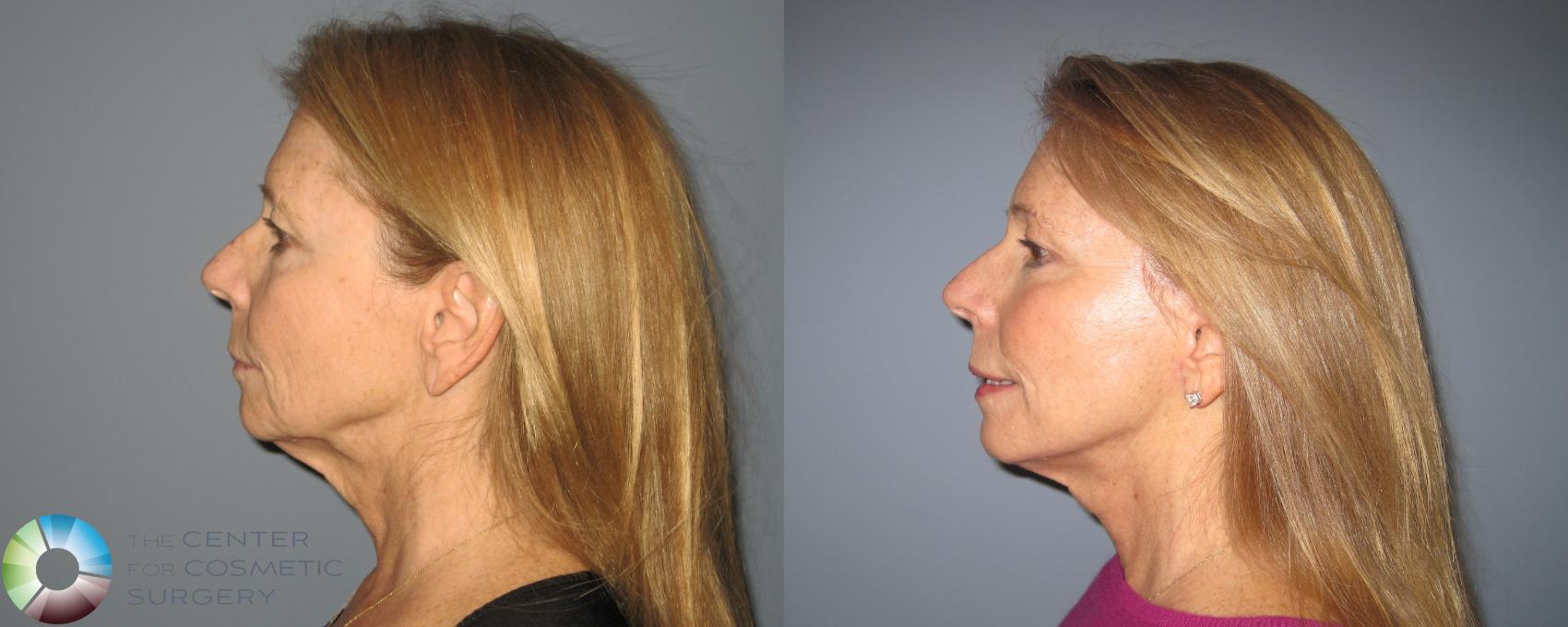 Before & After Mini Facelift Case 463 View #3 in Denver and Colorado Springs, CO