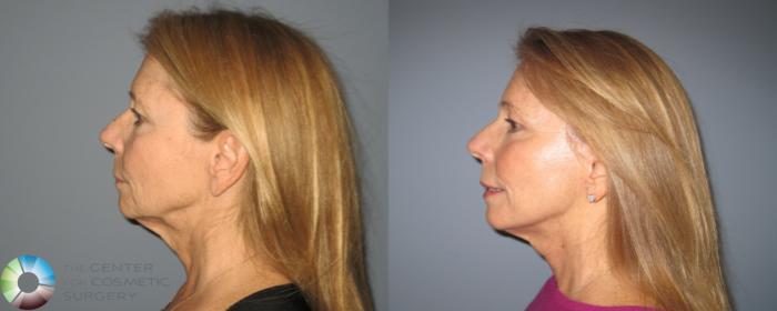 Before & After Mini Facelift Case 463 View #3 View in Golden, CO