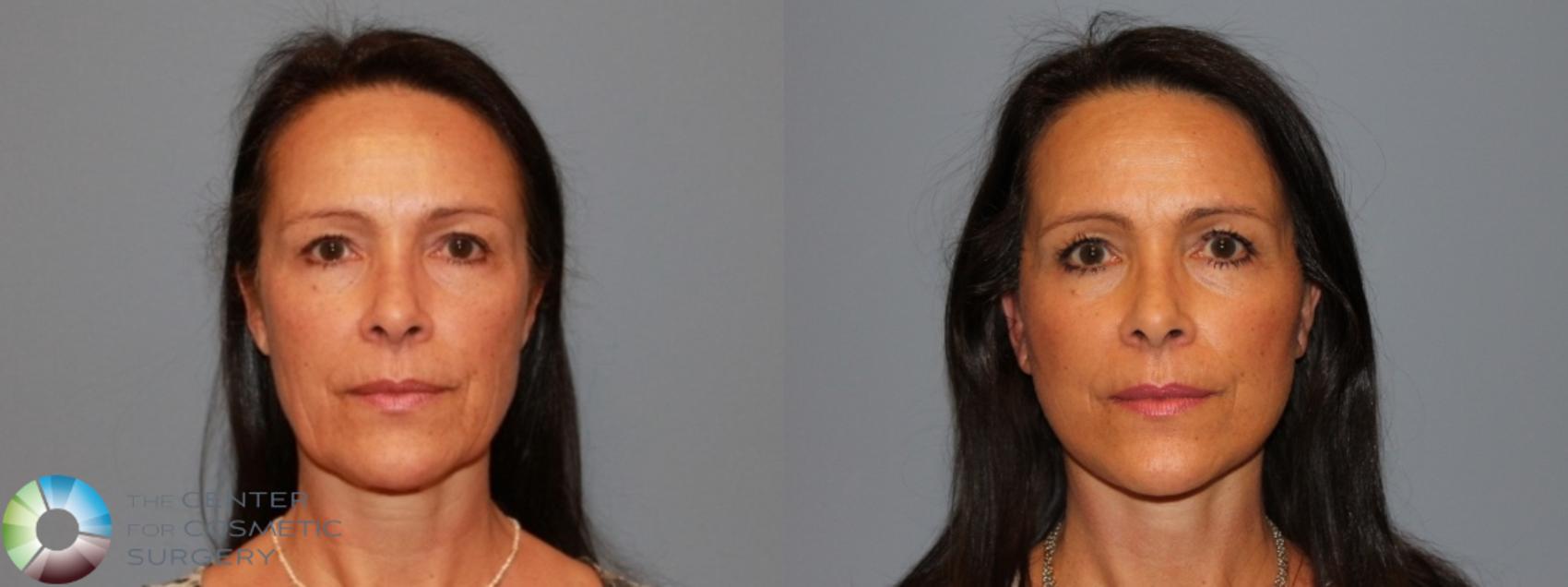 Before & After Facelift Case 464 View #1 in Denver and Colorado Springs, CO