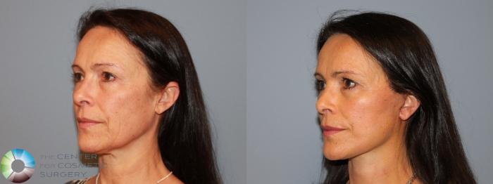 Before & After Mini Facelift Case 464 View #2 in Denver and Colorado Springs, CO