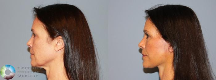 Before & After Mini Facelift Case 464 View #3 in Denver and Colorado Springs, CO