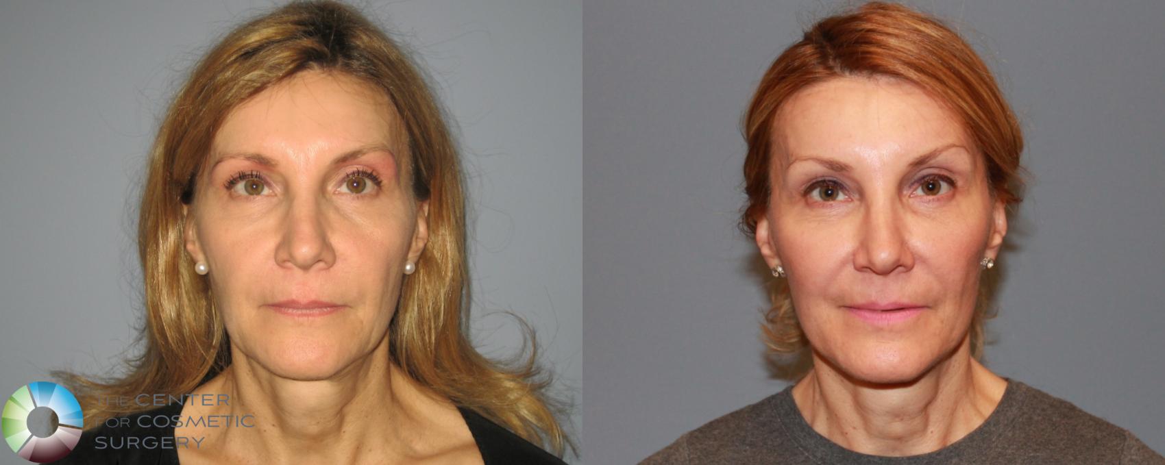 Before & After Mini Facelift Case 465 View #1 in Denver and Colorado Springs, CO