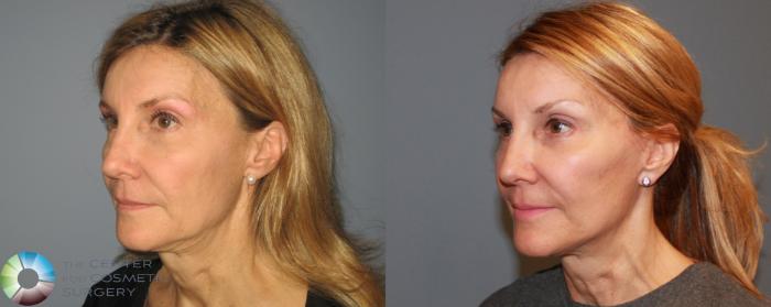Before & After Mini Facelift Case 465 View #2 in Denver and Colorado Springs, CO