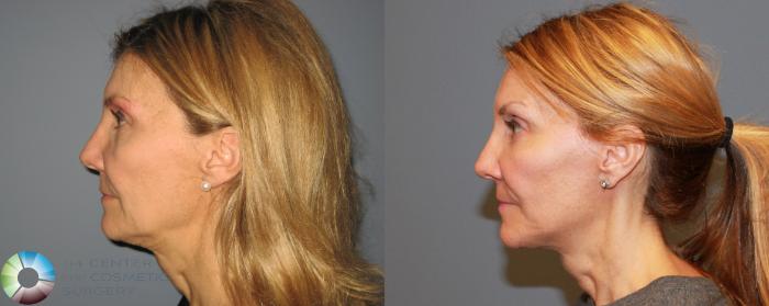 Before & After Mini Facelift Case 465 View #3 in Denver and Colorado Springs, CO