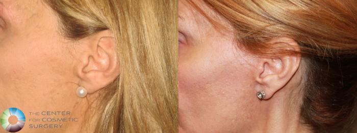Before & After Mini Facelift Case 465 View #4 in Denver and Colorado Springs, CO
