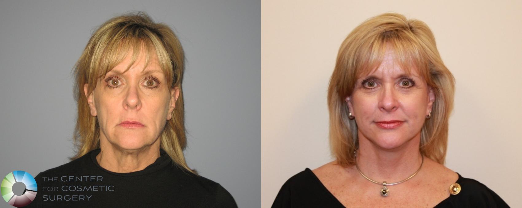 Before & After Mini Facelift Case 472 View #1 in Denver and Colorado Springs, CO