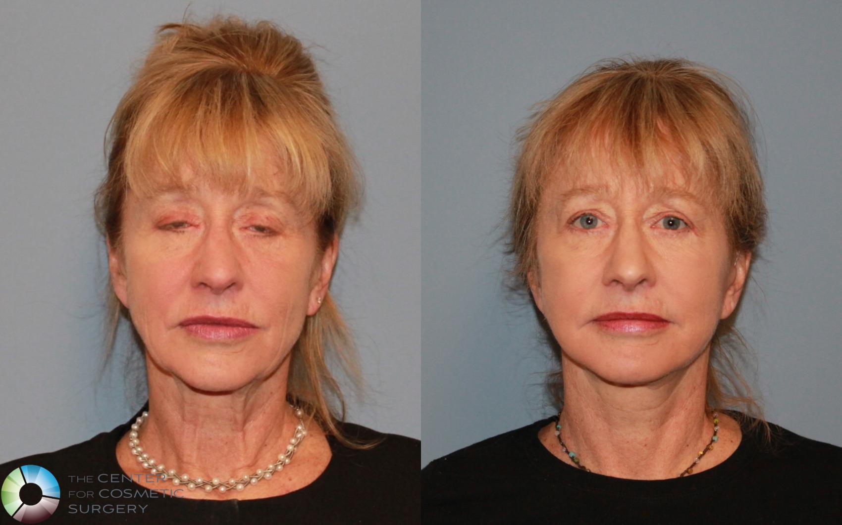 Before & After Facelift Case 476 View #1 in Denver and Colorado Springs, CO