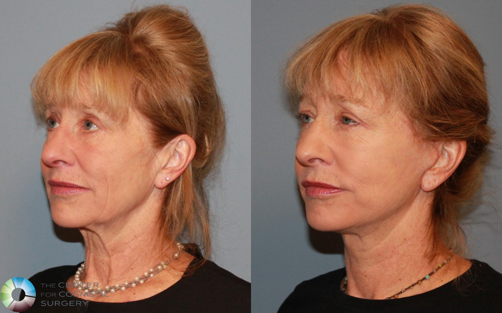 Before & After Mini Facelift Case 476 View #2 View in Golden, CO